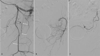 Prostatic arterial embolization as a micro-invasive treatment option for benign prostatic obstruction: A subtle balance between short-term follow-up patient-reported outcomes and de-obstructive effectiveness